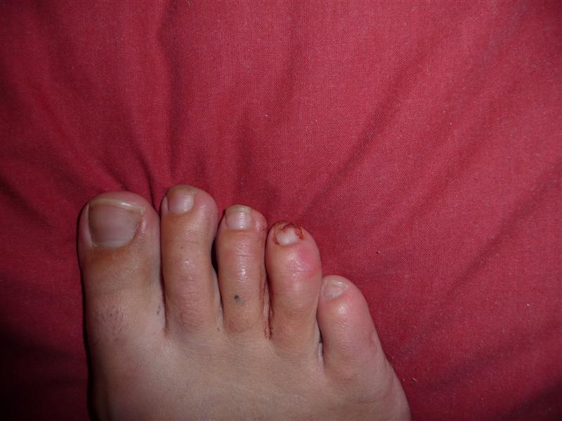 broken toenail